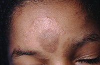 Tinea faciale secondary to T. Rubrum